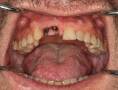 Άποψη των abutments στο στόμα - Οι στεφάνες συγκολλημένες