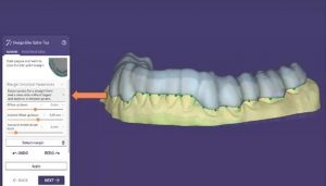 AI splints