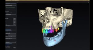 Seg teeth